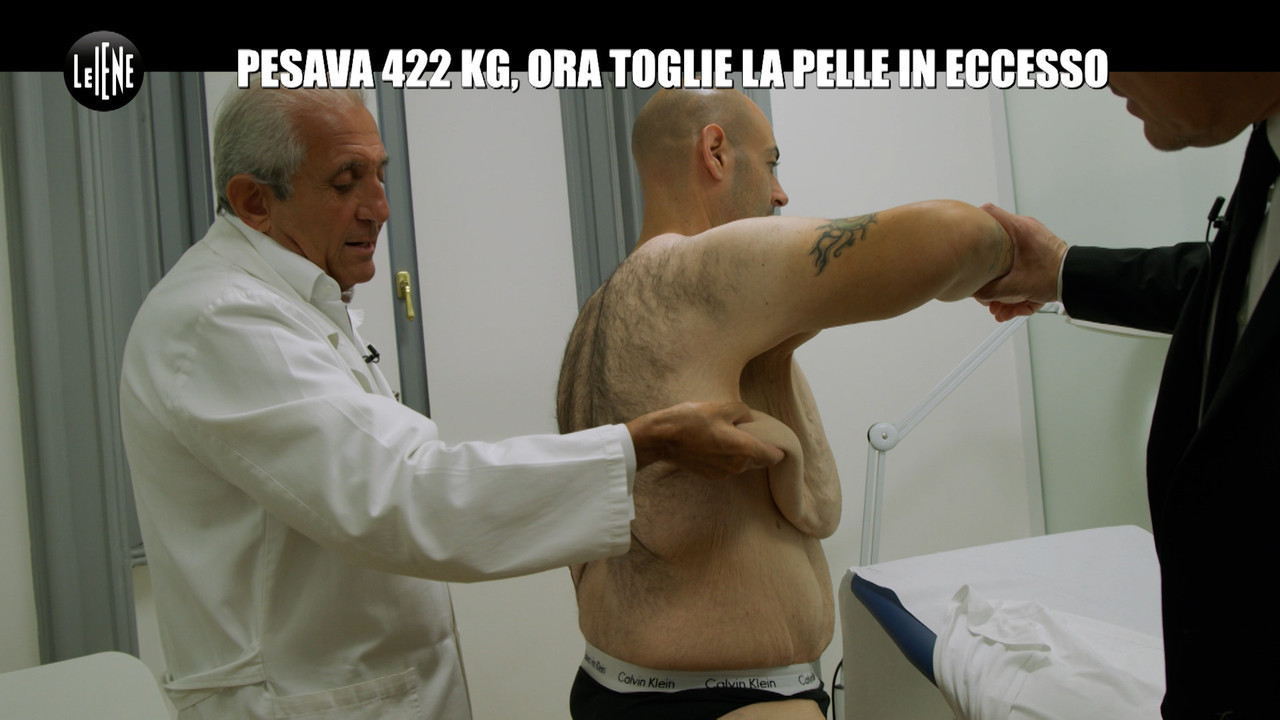 DE GIUSEPPE: Pesava 422 kg, ora fa l'operazione per togliere la pelle in eccesso