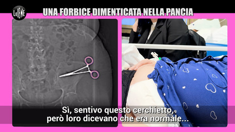 Una forbice dimenticata nella pancia